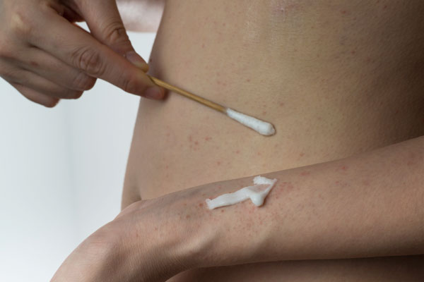 Behandlung von Schuppenflechte mit Creme